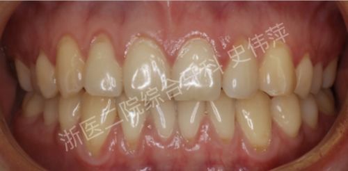 汽车抛光牙齿价格多少 汽车抛光牙齿价格多少